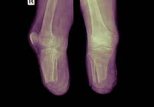 Dromen over amputatie spirituele betekenis symboliek