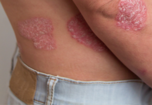 over psoriasis dromen spirituele betekenis symboliek