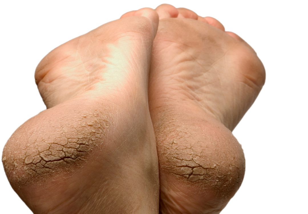 gebarsten hielen kloven spirituele betekenis symboliek droom dromen