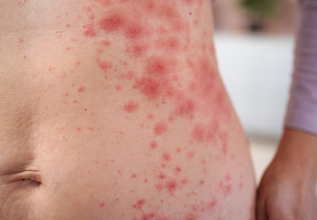 huiduitslag spirituele betekenis droom dromen symboliek